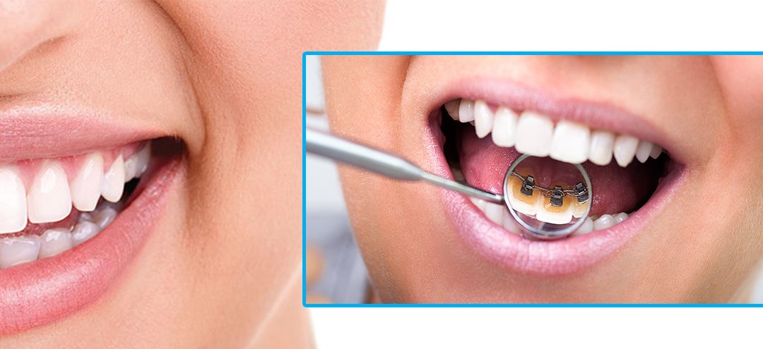 Ortodoncia Invisible  – Invisible Orthodontics